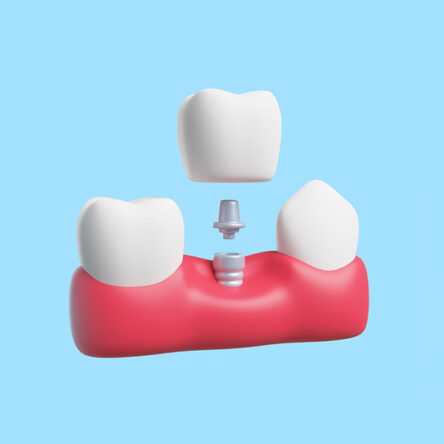 Choosing Dental Implants: Why iSmile Dental is Your Best Option