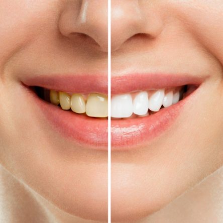 teeth whitening boca raton, cosmetic dentist boca raton, teeth whitening near me, dentist in boca raton