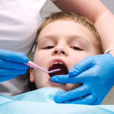 Fluoride Treatments in Boca Raton, FL, fluoride treatments near me, dentist in Boca Raton, FL