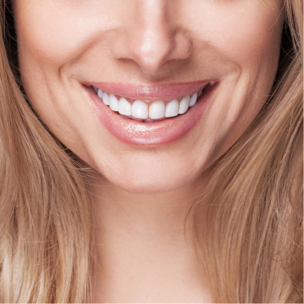 Professional Whitening