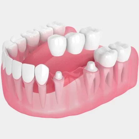 Dental Bridges in Boca Raton, Dental Bridges near you