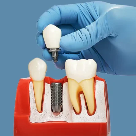 Dental Implants in Boca Raton, FL, Dental Implants near you