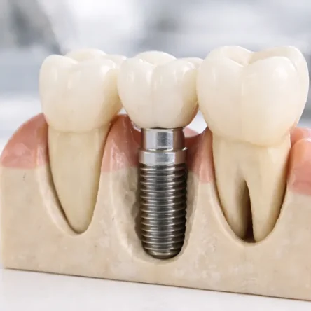 Dental Implant Provider in Boca Raton, Dental Implant near me